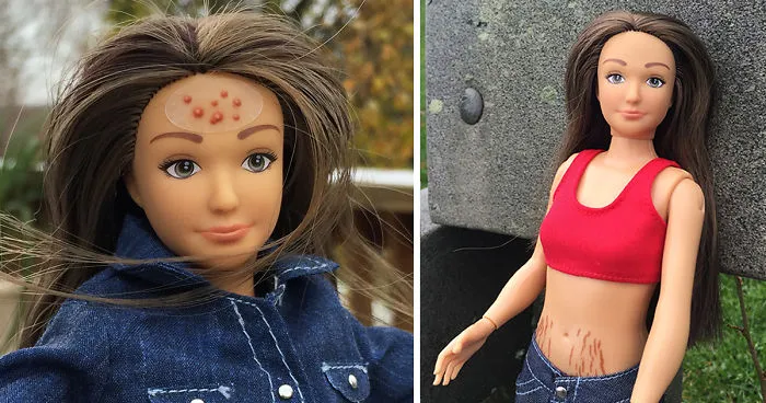 "Normal Barbie" Has Realistic 19-Year-Old Body Shape With Acne, Bruises And Stretch Marks