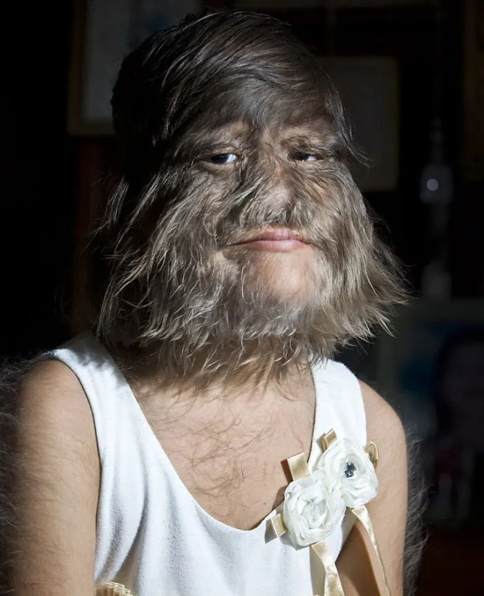 A Woman With Ambras Syndrome. In The Middle Ages, These People Were Called Werewolves