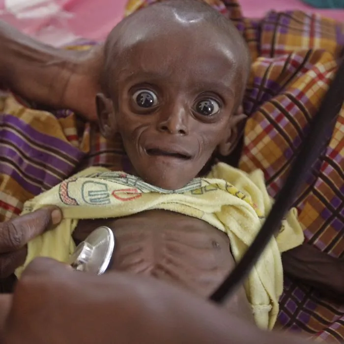 Malnutrition