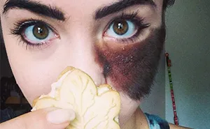 People Told Her To Remove Her Birthmark, But She Chose To Embrace It Instead