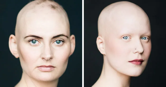 Baldvin: I Photograph Women With Alopecia To Break Gender Stereotypes