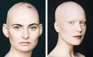 Baldvin: I Photograph Women With Alopecia To Break Gender Stereotypes