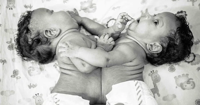 These 2-Months-Old Conjoined Twins Share One Liver And I Had The Honor To Photograph Them