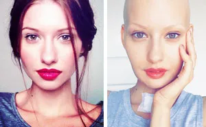 Doctors Told Model To Abort Her Child After She Lost 95% Of Her Jaw To Cancer. This Is What She Did