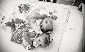Conjoined Twins After Separation Surgery