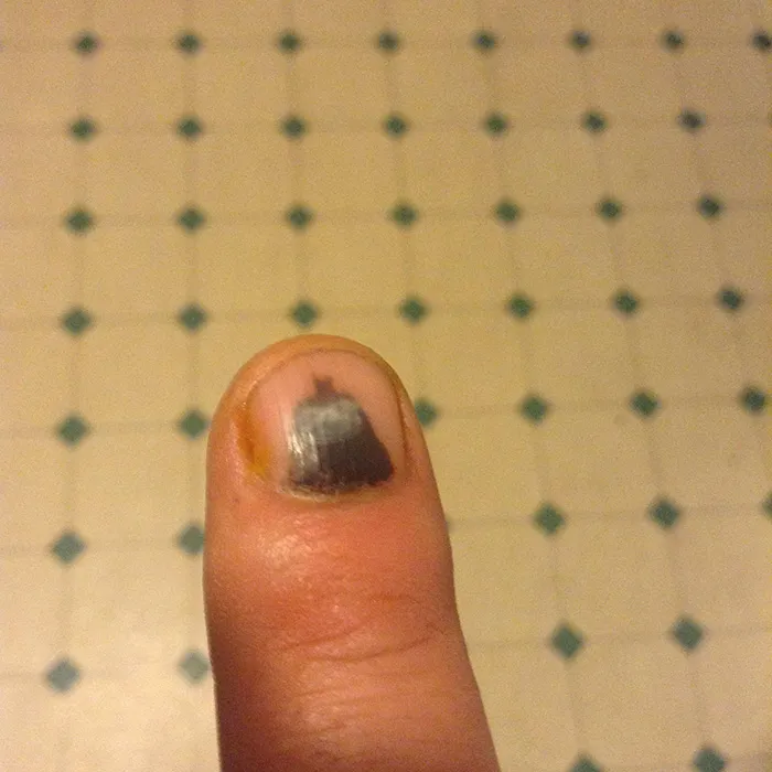 My Smashed Finger Looks Like Batman And A Little Like A Sloth