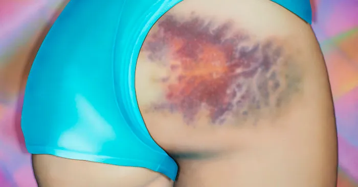 The Beauty Of Bruises: I Captured These Mini-Galaxies On The Butts Of Roller-Derby Girls