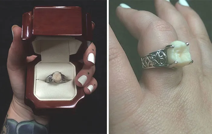 This Woman Got An Engagement Ring With Her Fiance's Wisdom Tooth