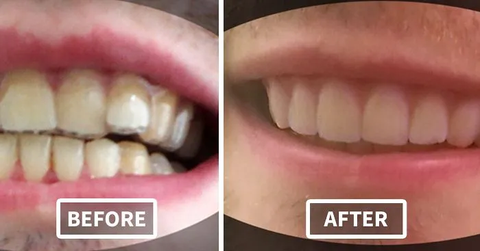 College Student Makes His Own DIY Braces For $60, Saves Thousands Of Dollars