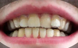 College Student Makes His Own DIY Braces For $60, Saves Thousands Of Dollars