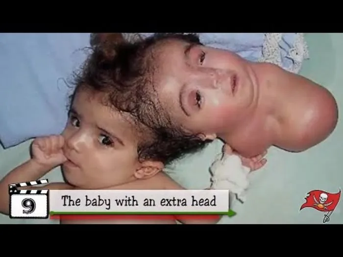 15 People Who Were Born With Extra Body Parts