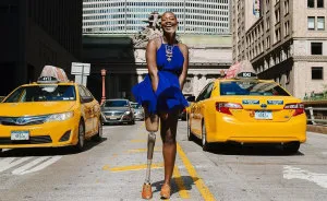 Amputee Woman Who Was Given 3 Weeks To Live Becomes Famous Fashion Blogger