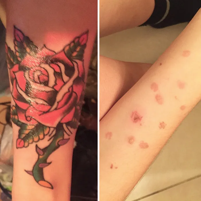 The Scars Are Gone & Covered With Beautiful Work