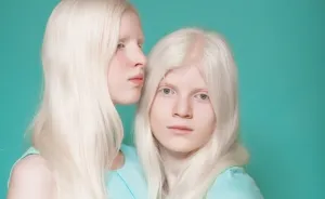 We Took Photographs Of Albino Kids To Show Their Pure Beauty