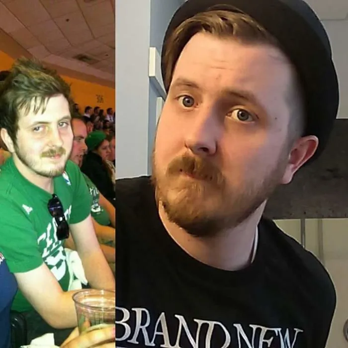 Side-by-side before and after photos showing facial changes after quitting drinking, highlighting health improvements.