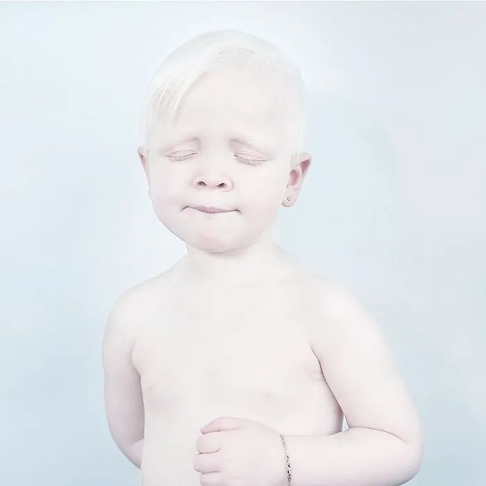 Albino Boy