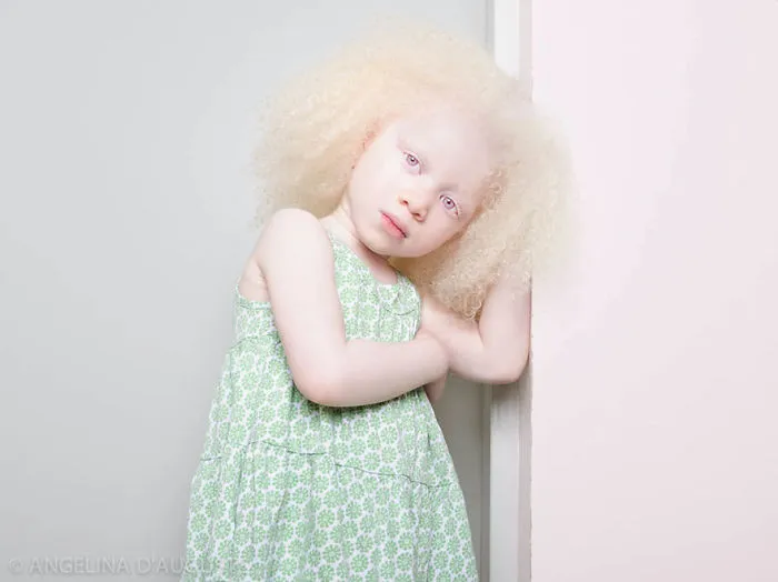 Albino Girl