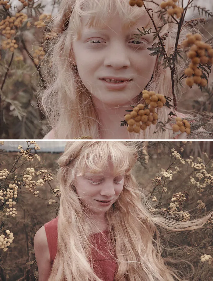 Beauty Of Albino Girl