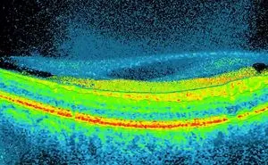 Medlikbez/eye Floaters. What Is It?