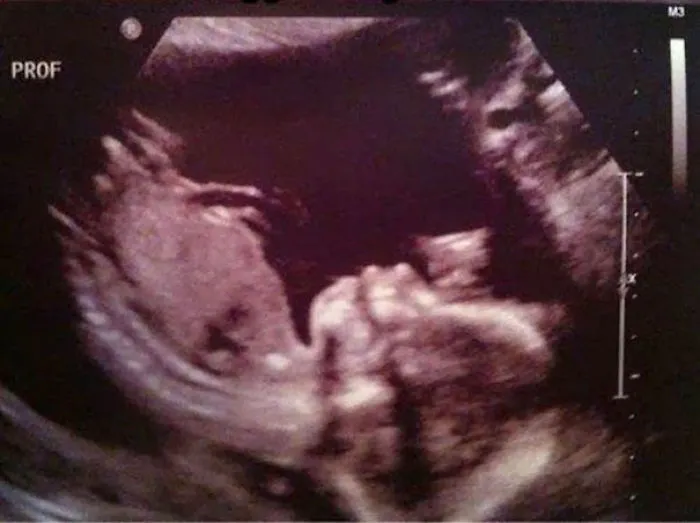 Ultrasound image with a hidden detail that’ll freak you out when you see it.