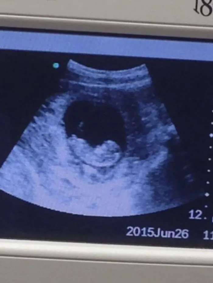 Ultrasound image with a hidden surprise to find, dated June 26, 2015.