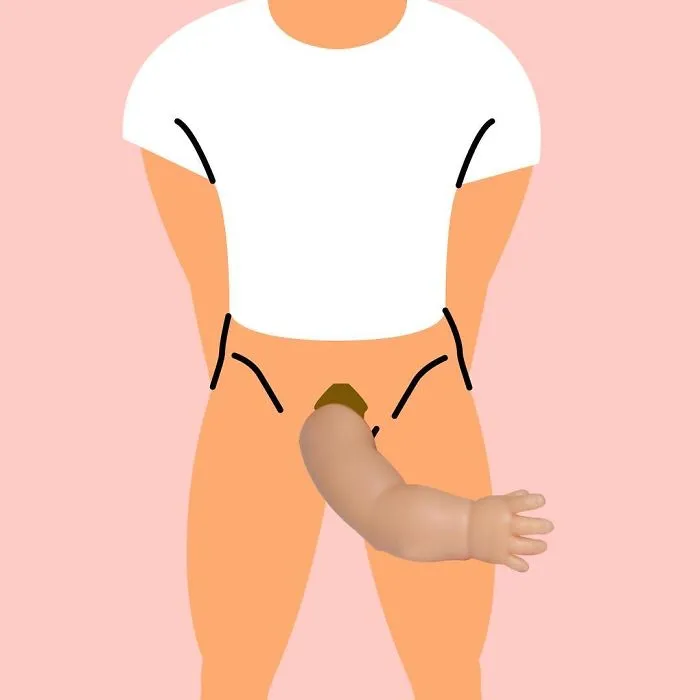 France - Bras D'enfant, Alias 'Baby Arm'