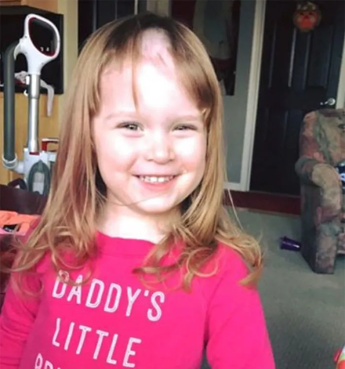 Child with self-cut hair, smiling in a pink shirt, showing a patch of missing hair on the forehead.