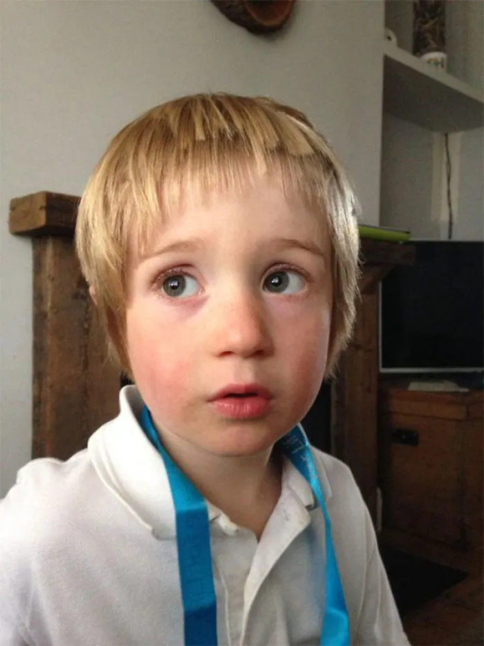Young child with a self-cut hairstyle, looking surprised and wearing a white shirt and blue ribbon.