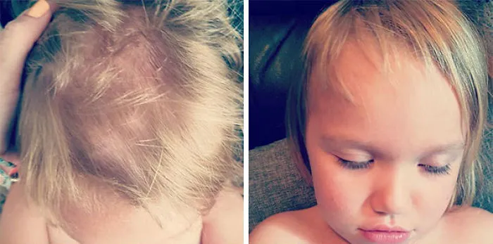 Child with self-cut hair; close-up of uneven haircut with visible scalp.