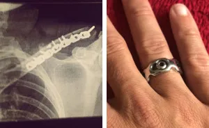 I Made A Ring Out Of The Metal Plate From My Surgery