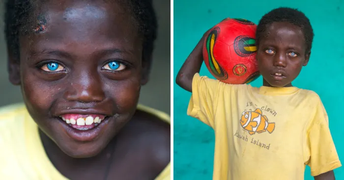 I Met Ethiopian Boy With The Plastic Eyes