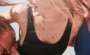 We Stuck Pimples On Billboards To Make Ads More Realistic