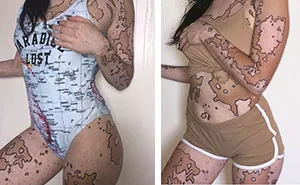 After Being Bullied For Vitiligo All Her Life, This Girl Now Turns Her Body Into Amazing Art
