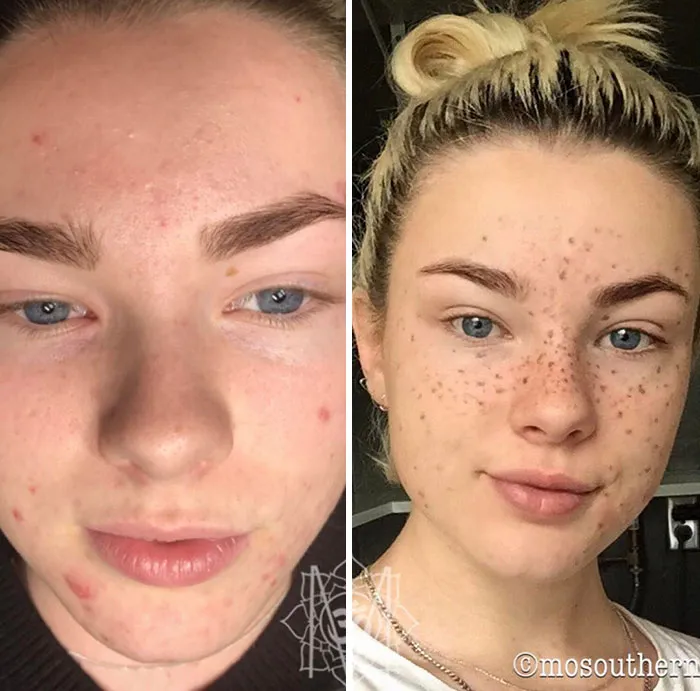 Tattooing Freckles On Your Face Is The New Beauty Craze, And They Look Surprisingly Beautiful