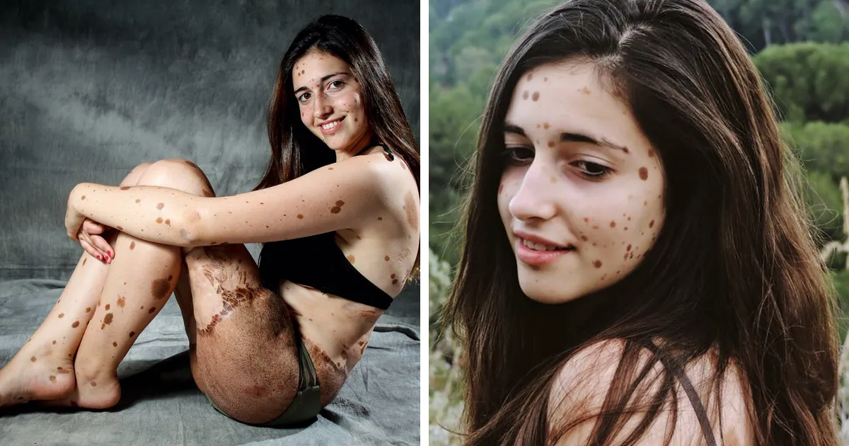 Esta adolescente española fue brutalmente acosada por tener más de 500 manchas de nacimiento, pero solo hay que verla ahora