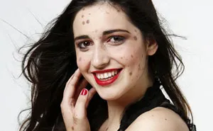This Teen Was Brutally Bullied For Having Over 500 Birthmarks, But Look At Her Now