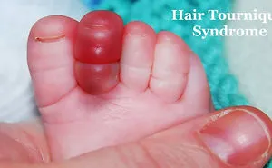 How A Single Hair Can Have Serious Consequences For A Baby