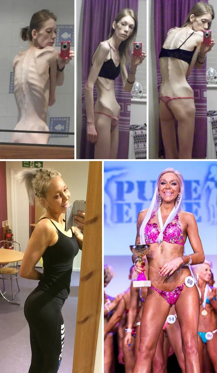 Nicola King, su enfermedad hizo que le fallaran los órganos, pero luchó y se recuperó hasta convertirse en campeona de culturismo
