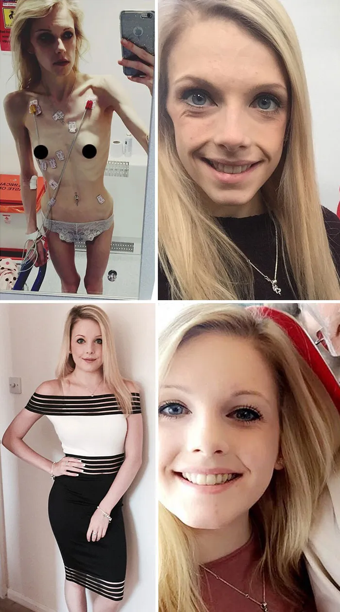 Jodie-Leigh Neil desarrolló la enfermedad después de que su mejor amiga muriera en un accidente. Si no se recuperaba, iba a morir