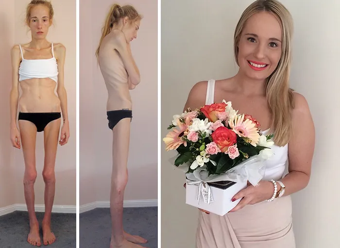 Gemma Walker, llegaron a pensar que solo viviría 48 horas. Su padre comprobaba que siguiera respirando por las mañanas