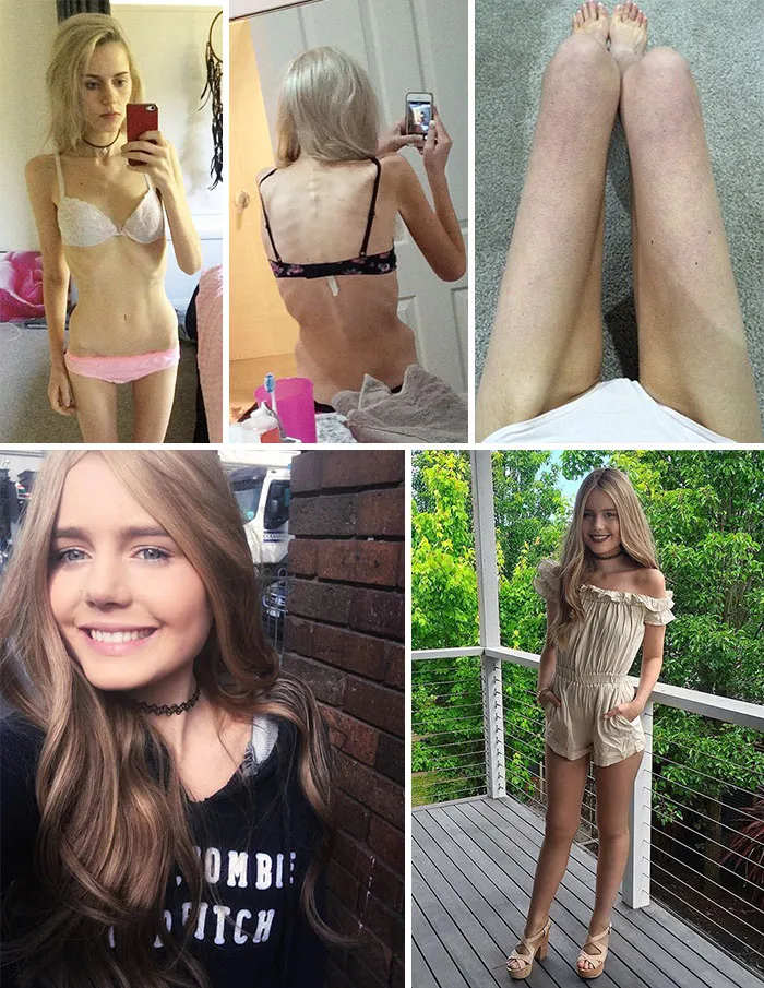 Elle Lietzow no quería ni beber agua. Tras una semana, tuvo un ataque y acabó en el hospital