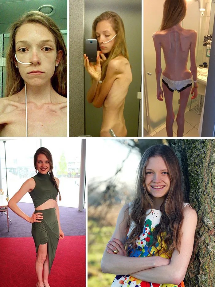 Hannah con un IMC de 11, y tras recuperarse