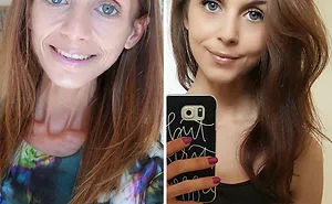 120 Before & After Pics Of People Who Defeated Anorexia
