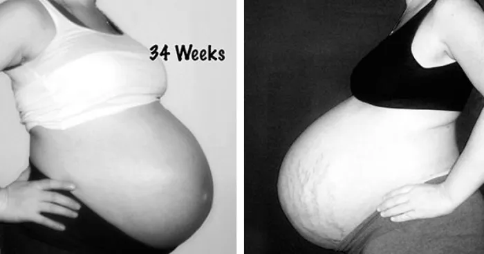 Side By Side Comparison Of My Singleton Pregnancy And My Twin Pregnancy