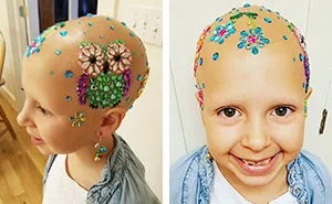 This 7-Year-Old Girl Didn't Let Alopecia Stop Her From Dazzling Everyone At School On Crazy Hair Day