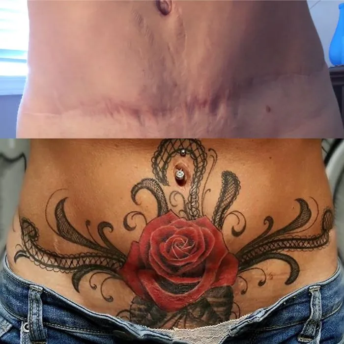 Rose tattoo beautifully transforming stomach scars into art, featuring intricate designs above jeans.