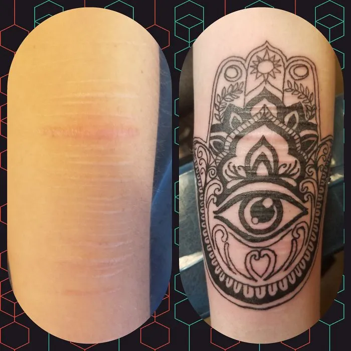 Scar covered by intricate tattoo art, transforming it into a creative design.