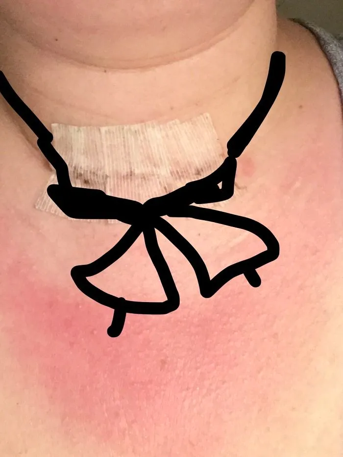 Tattoo design converting neck scar into art with a creative bow illustration.