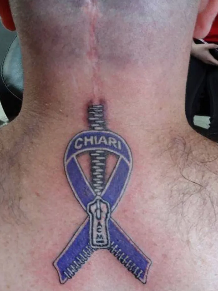 Tattoo transforms a neck scar into artwork with a zipper and "Chiari" text, emphasizing amazing tattoos on scars.
