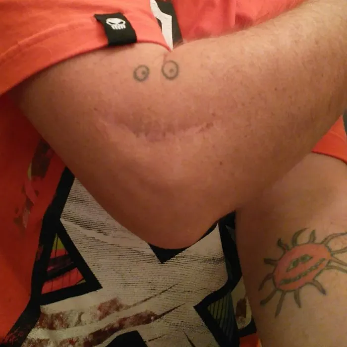 Tattoo art creatively transforms a scar on an arm into a cheerful smiley face design.